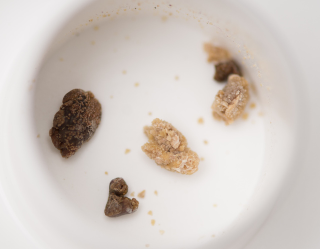 Kidney stones: The bigger they are, they harder—and more excruciatingly painful—they are to pass. (Image: G.L. Kohuth, Michigan State University)
